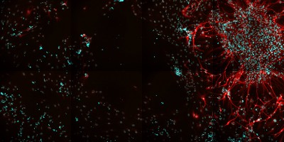 Frontotemporal Demetia
