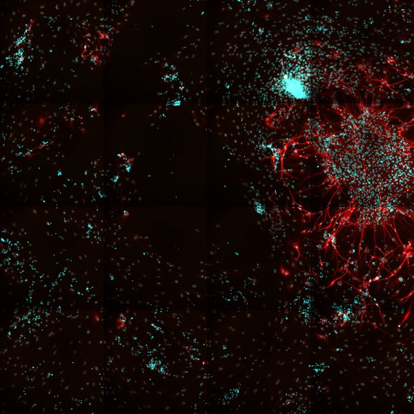 Frontotemporal Demetia
